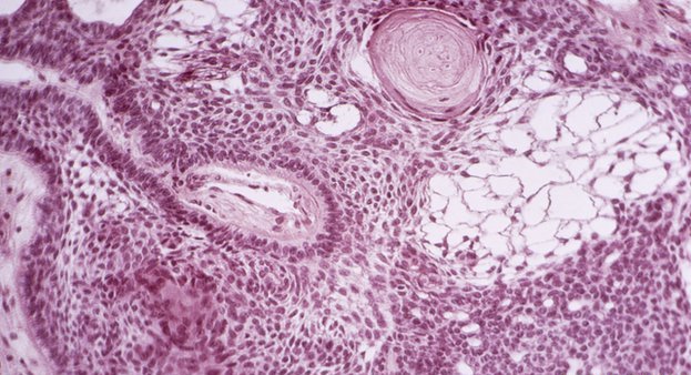 Celulele care distrug cancerul