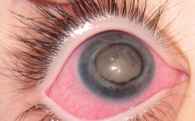 Boala Coats ?falsa diagnosticare cu glaucom sau cataractă