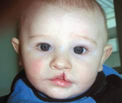 Speranta pentru copiii cu malformatii