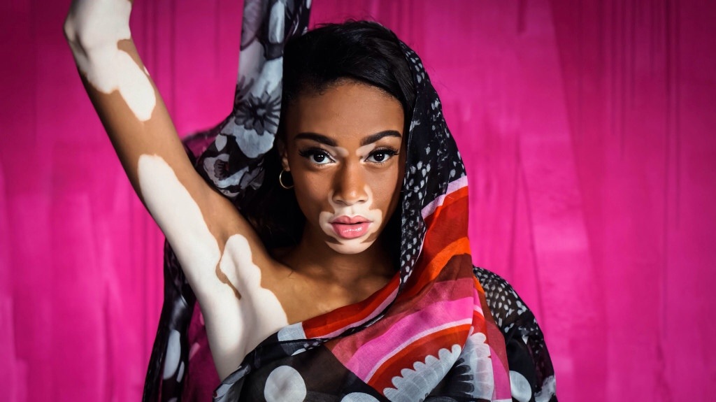 Picture of the Day: Top model with Vitiligo