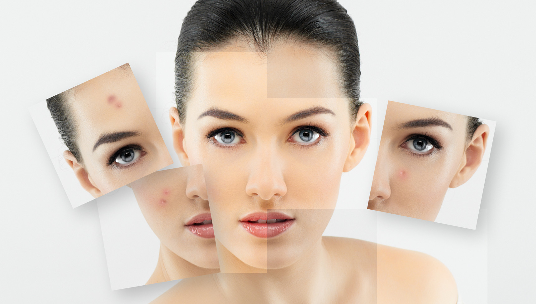 VIDEO Suferiti de acnee? Iata ce tratamente se recomanda ca sa evitam aparitia cicatricilor