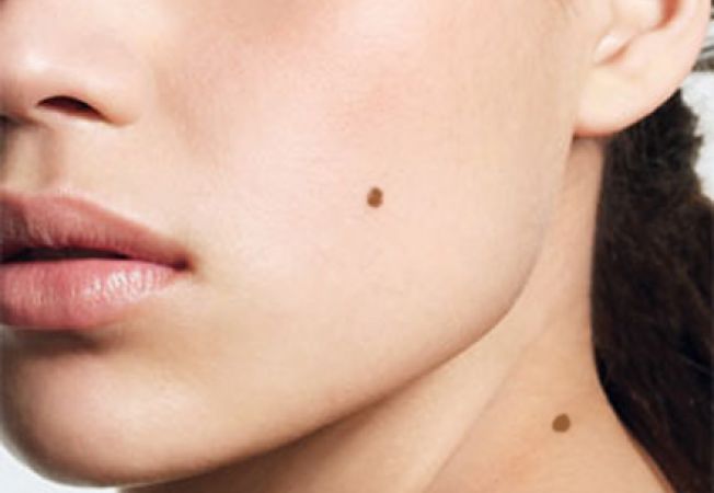 VIDEO Alunitele – principala cauza a cancerului de piele