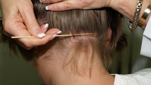 Păduchii merg la grădiniță!