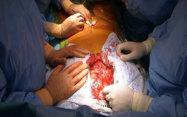 Transplant de inimă la Târgu Mureș (audio)