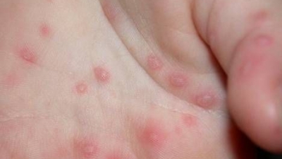 Infecții la preșcolari în Olt