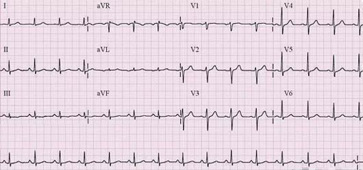 Cardiomiopatia hipertrofică