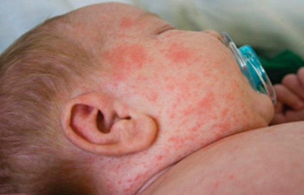 Epidemia de rujeolă