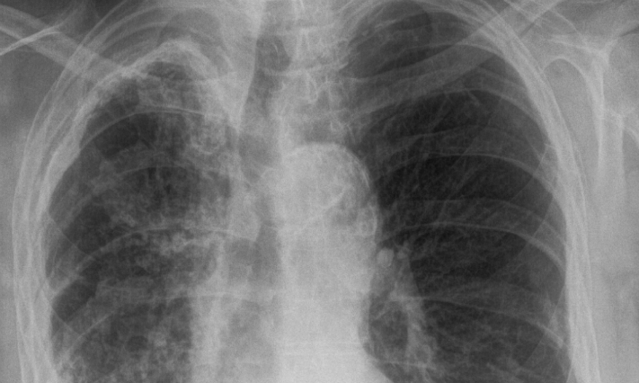 Pericol de epidemie TBC