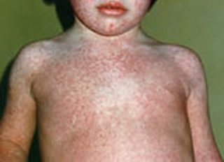 13 copii au murit de rujeolă