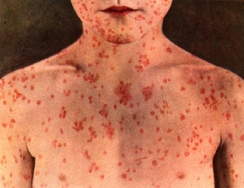 Raport privind situaţia vaccinării împotriva rujeolei (audio)