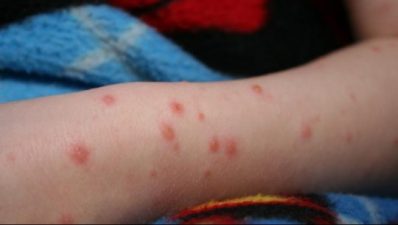 Noi cazuri de rujeolă