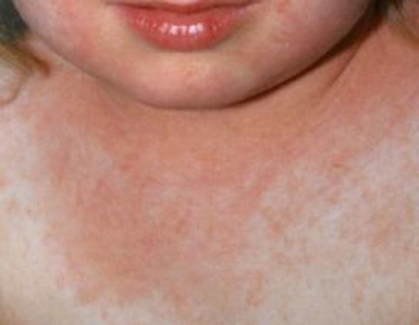 Scarlatină la grădiniţă