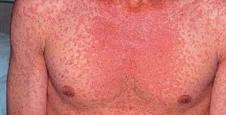 Ucraina – Focare de rujeolă (pojar)