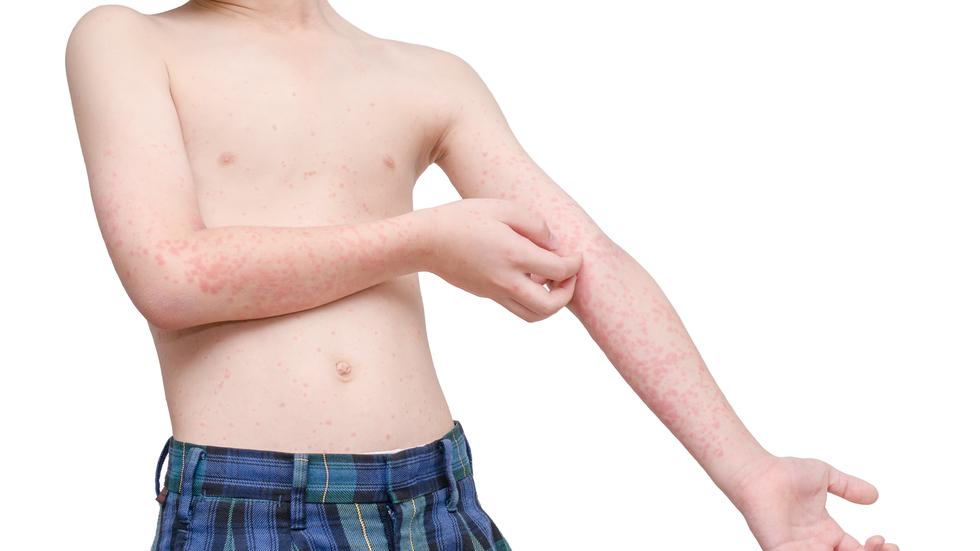 Focar de rujeolă la Slatina