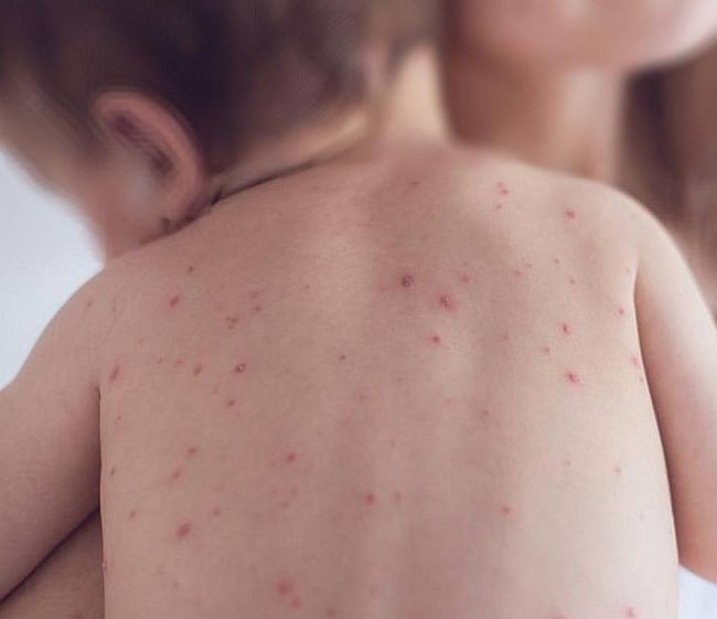 Focare de varicelă (audio)