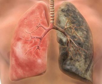 Aproape un sfert din decesele înregistrate în anul 2016 în Uniunea Europeană au fost cauzate de cancerul pulmonar