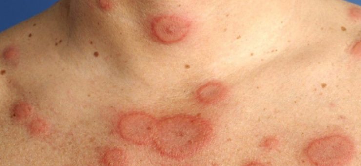 Supraveghere epidemiologică (audio)