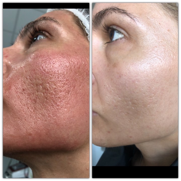 Microneedling, tratamentul-minune pentru tenul cu probleme!